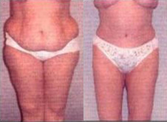 Before & After Liposuction Case 3735 View 1 View in Houston, TX