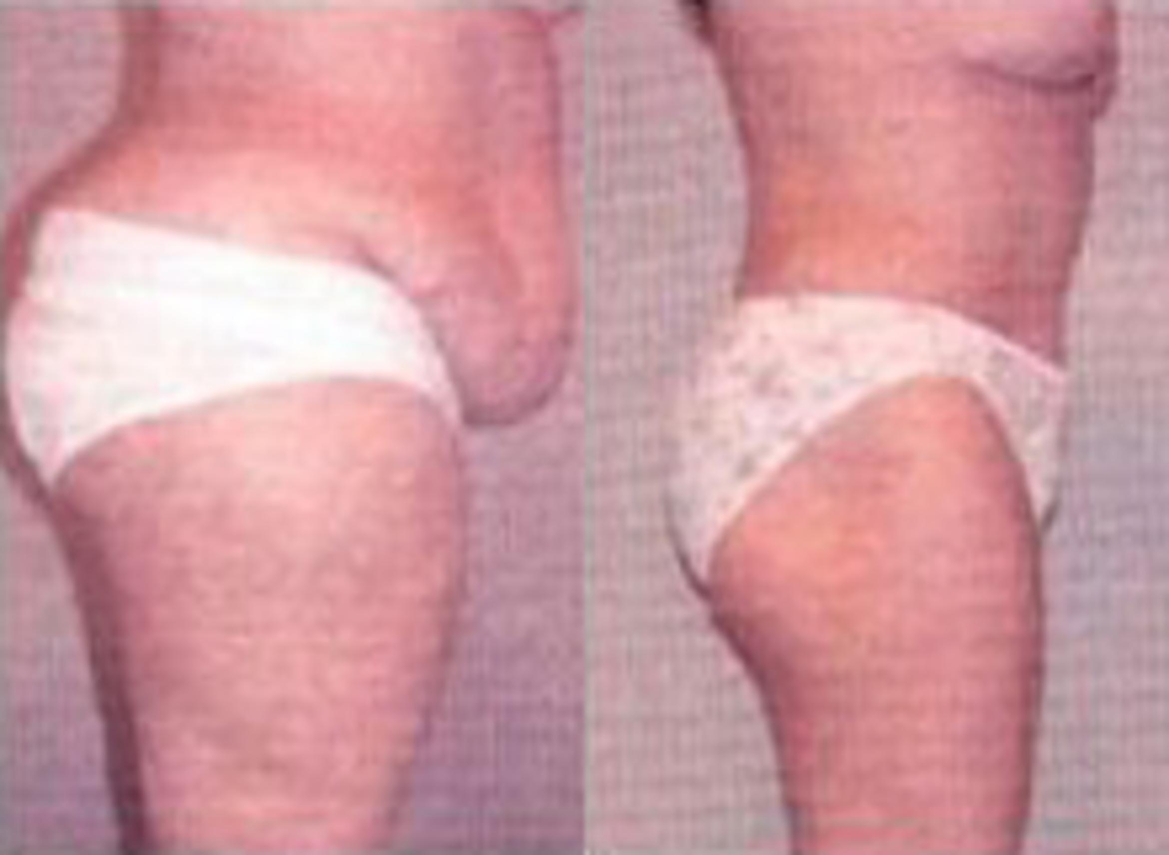 Before & After Liposuction Case 3735 View 2 View in Houston, TX