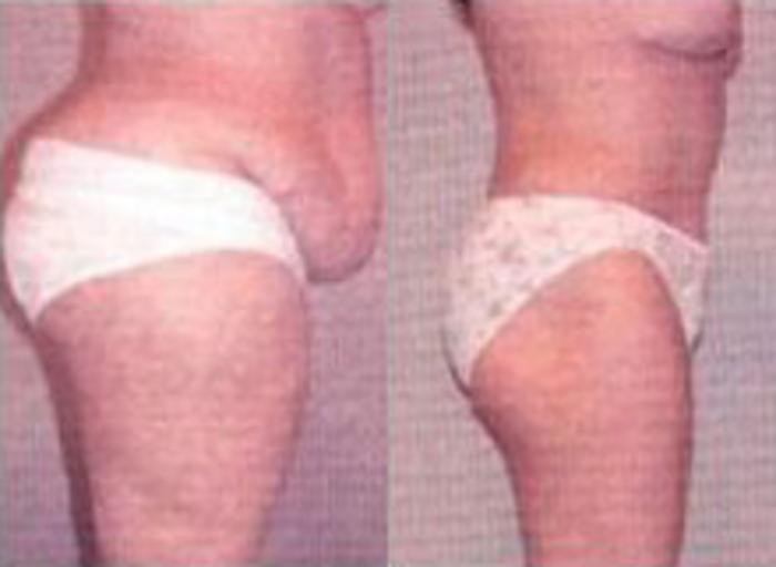 Before & After Liposuction Case 3735 View 2 View in Houston, TX
