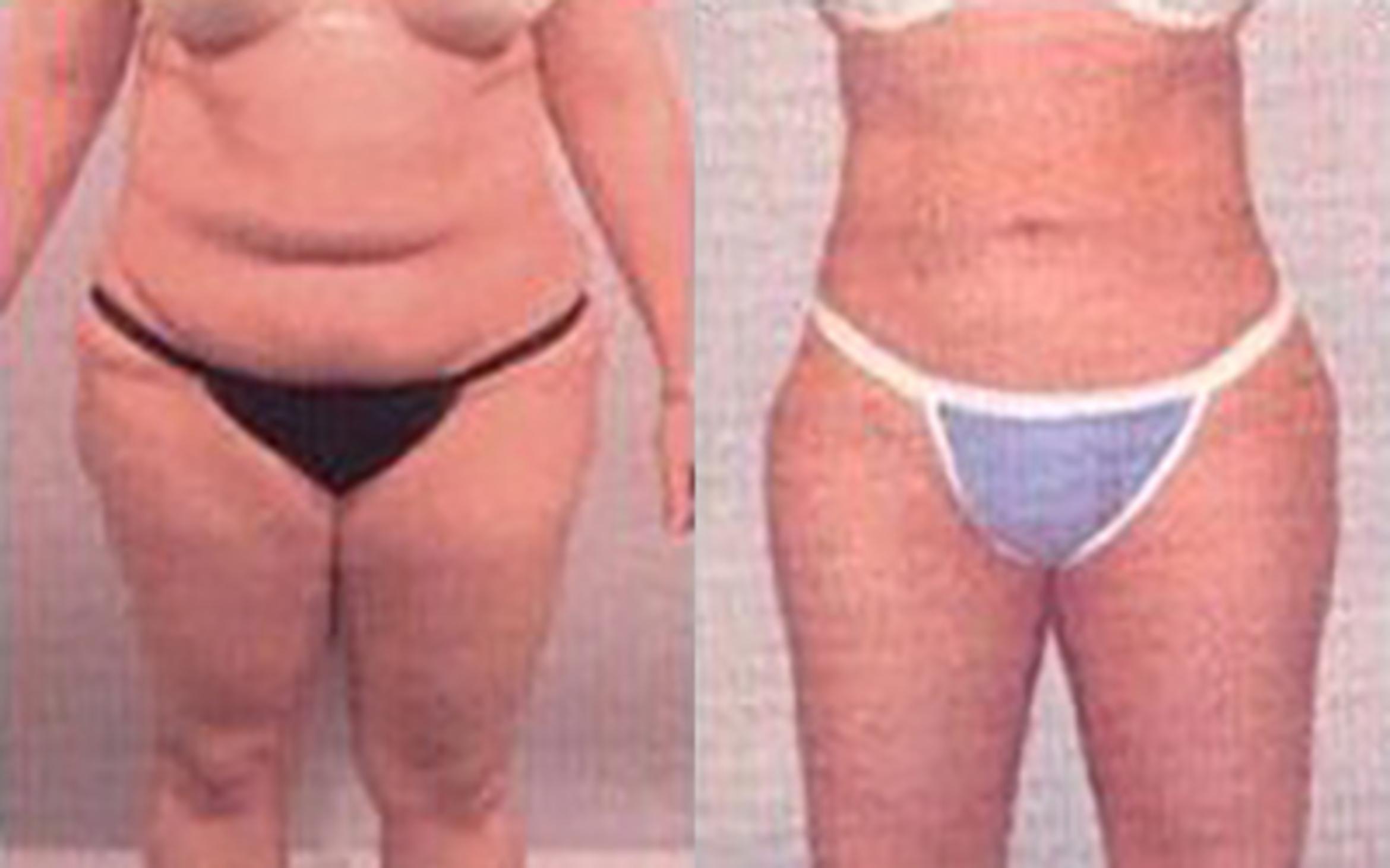 Before & After Liposuction Case 3741 View 1 View in Houston, TX