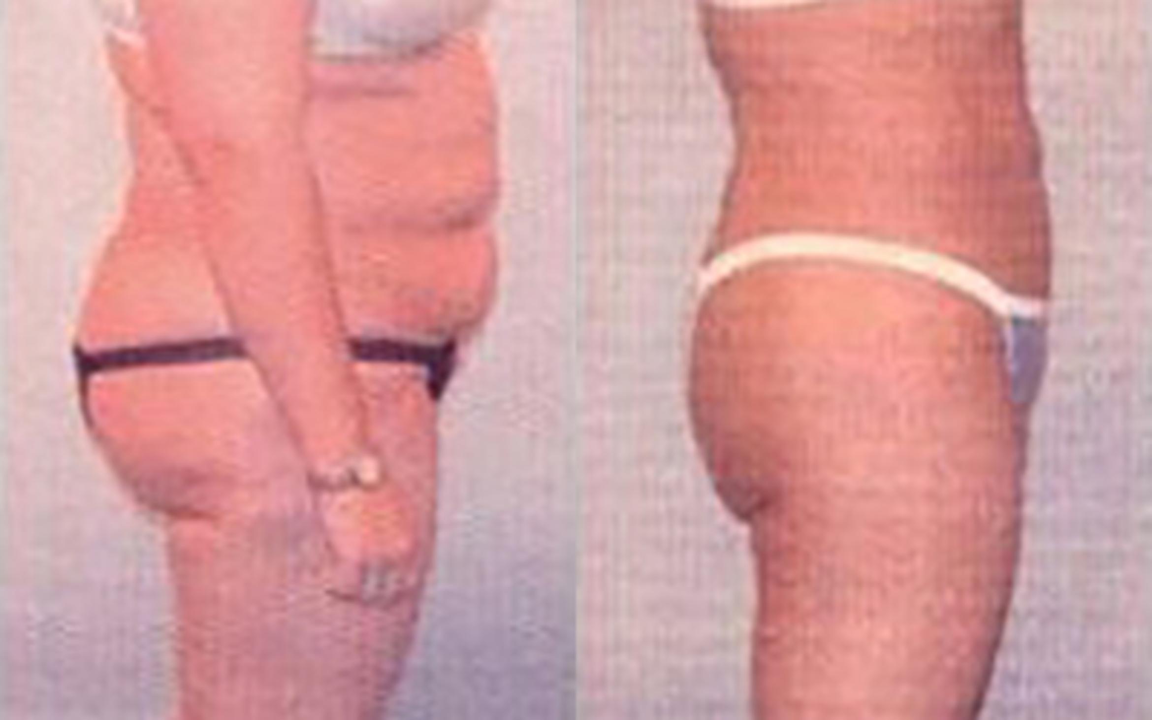 Before & After Liposuction Case 3741 View 2 View in Houston, TX