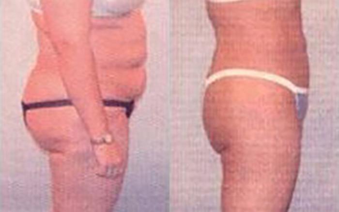 Before & After Liposuction Case 3741 View 2 View in Houston, TX