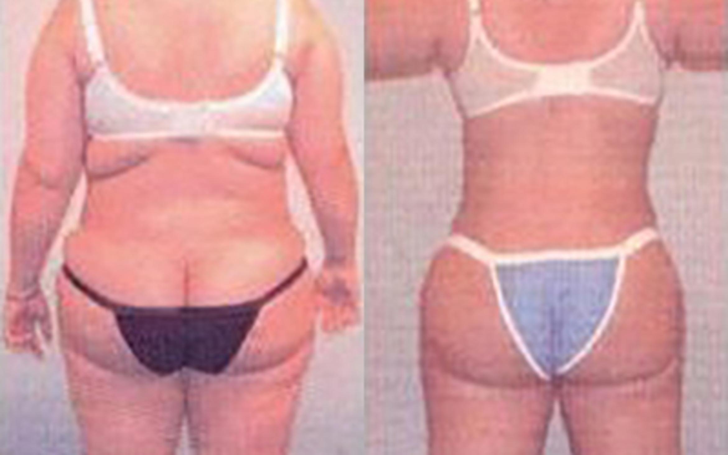 Before & After Liposuction Case 3741 View 3 View in Houston, TX