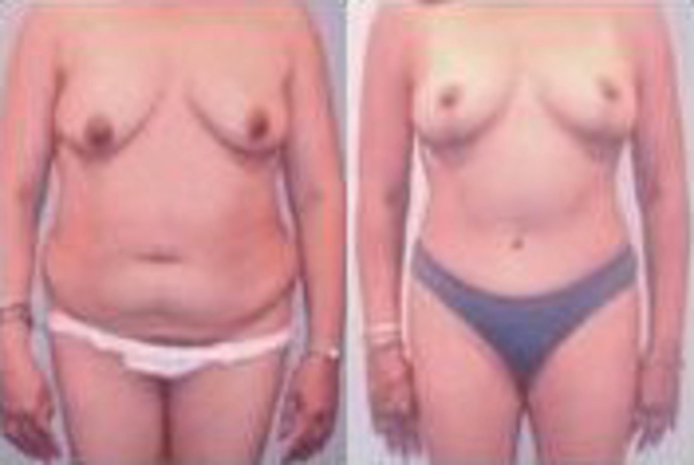 Before & After Liposuction Case 3749 View 1 View in Houston, TX