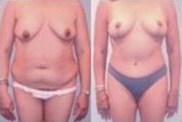 Before & After Liposuction Case 3749 View 1 View in Houston, TX
