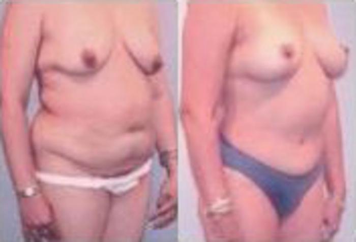 Before & After Liposuction Case 3749 View 2 View in Houston, TX