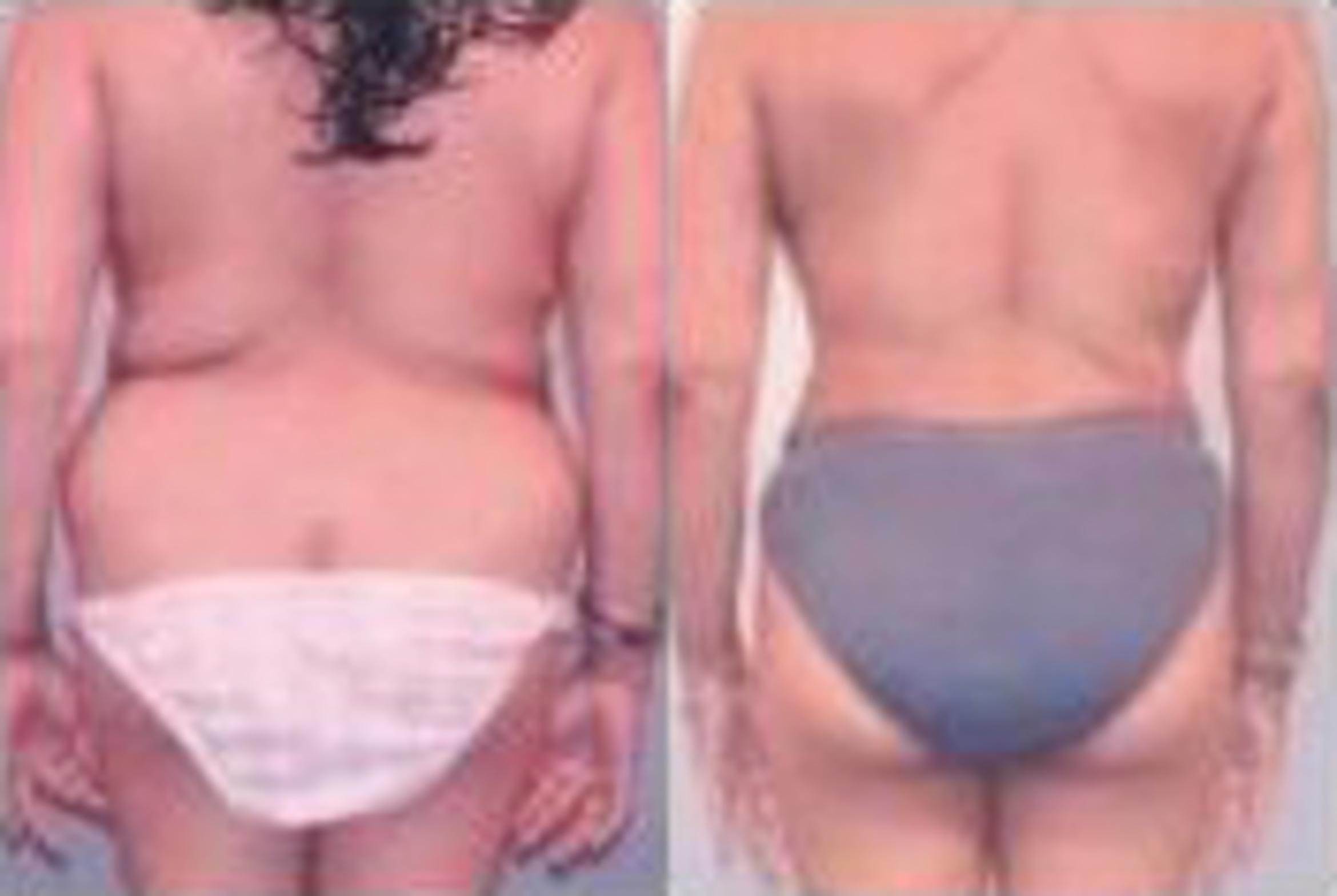 Before & After Liposuction Case 3749 View 3 View in Houston, TX