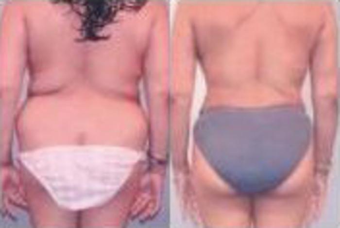 Before & After Liposuction Case 3749 View 3 View in Houston, TX