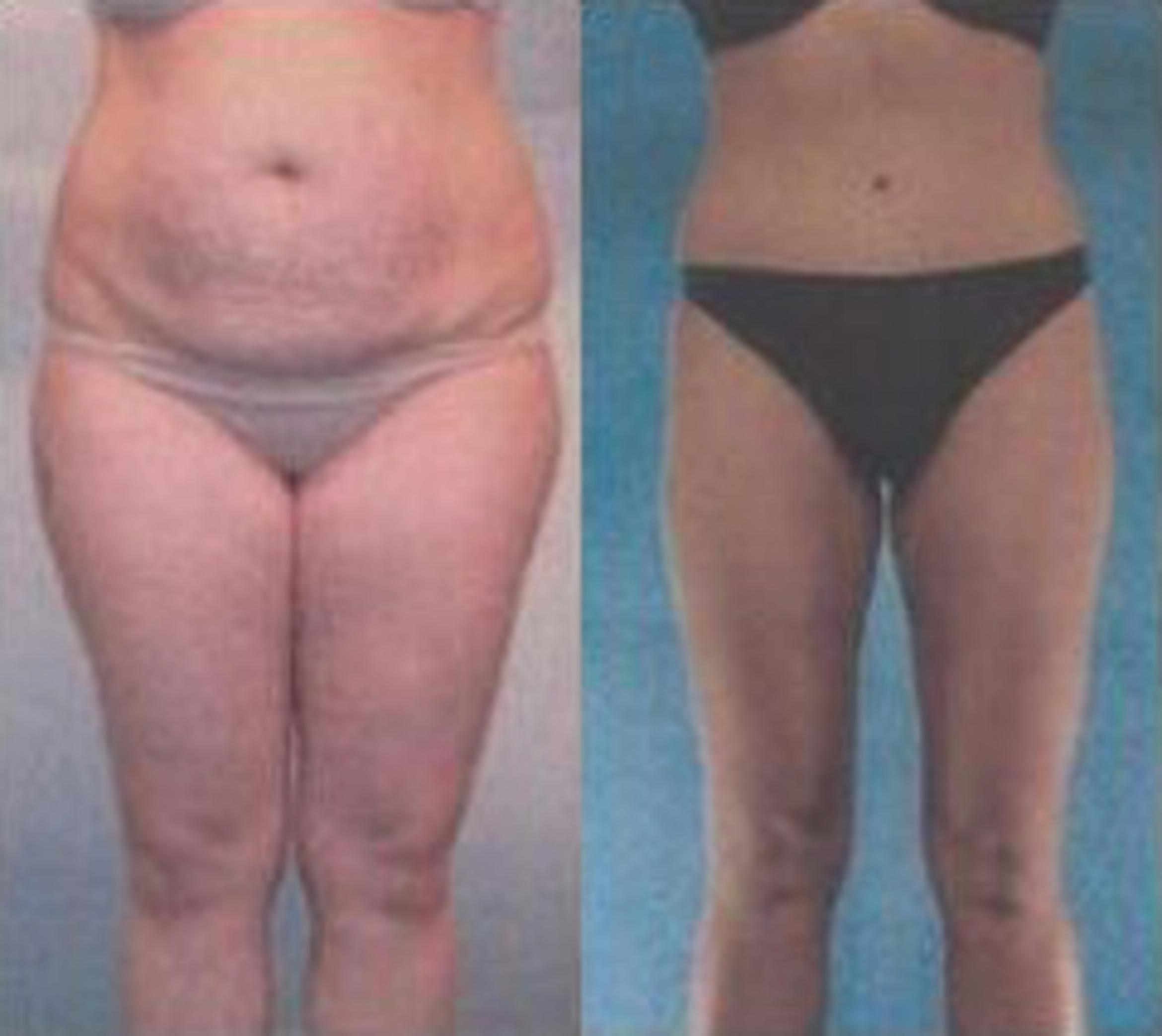Before & After Liposuction Case 3757 View 1 View in Houston, TX