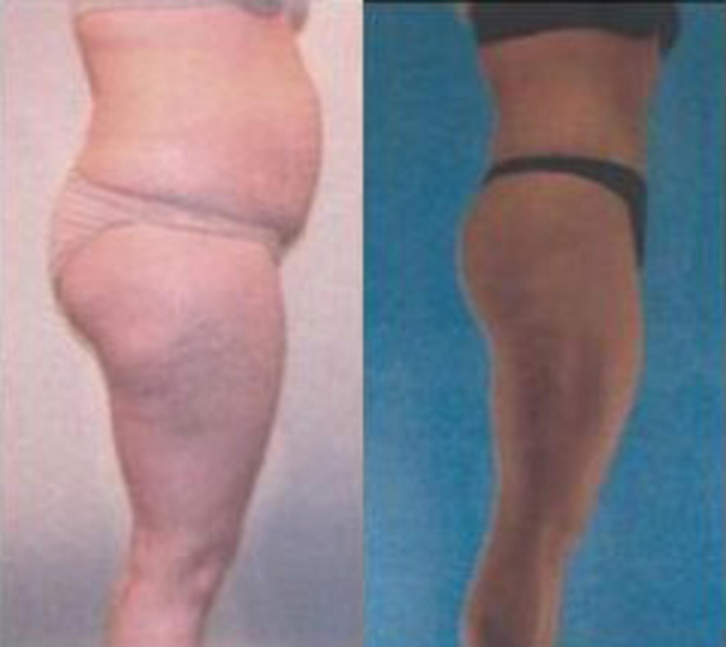 Before & After Liposuction Case 3757 View 2 View in Houston, TX