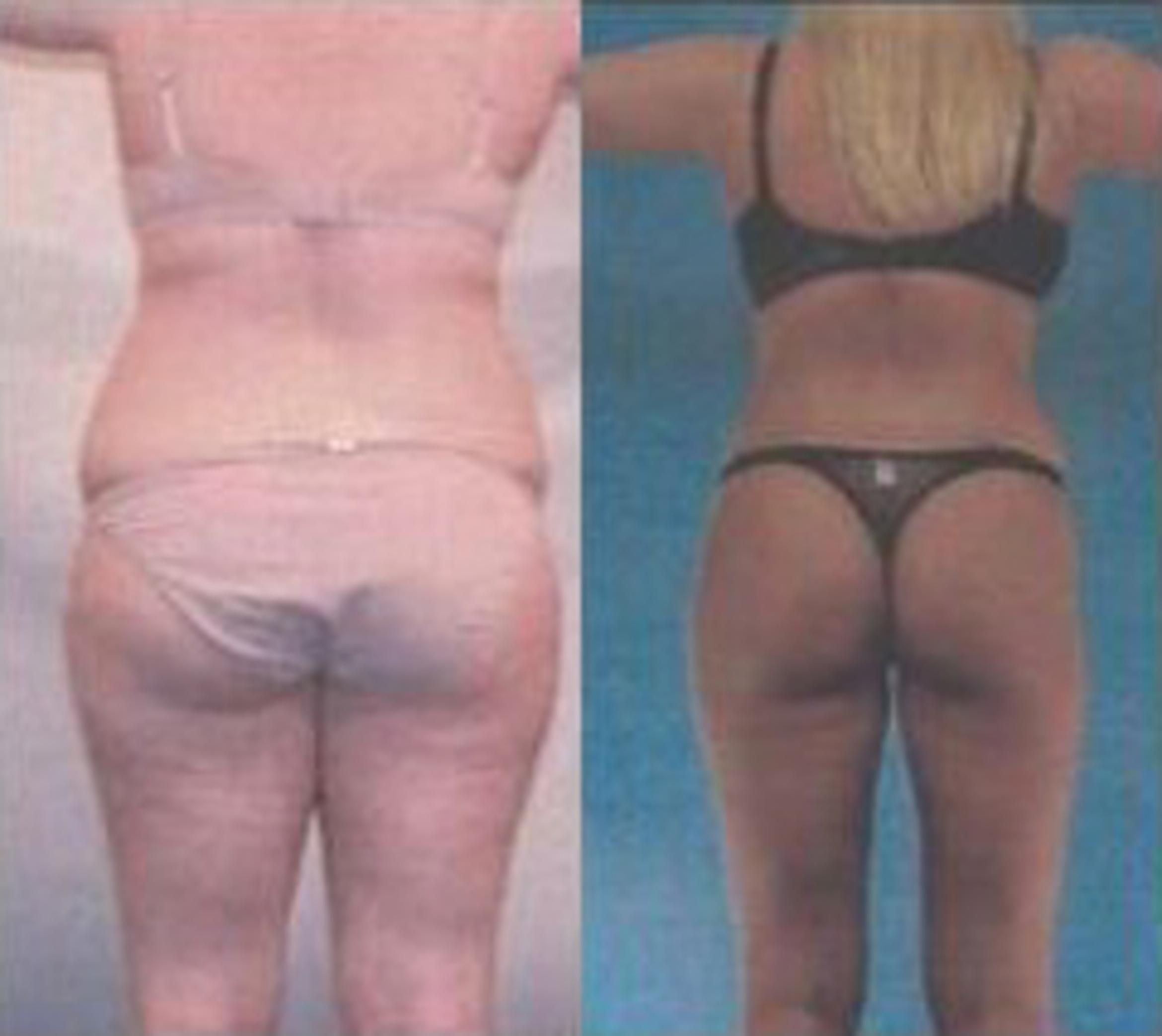 Before & After Liposuction Case 3757 View 3 View in Houston, TX