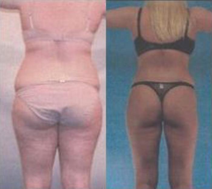Before & After Liposuction Case 3757 View 3 View in Houston, TX