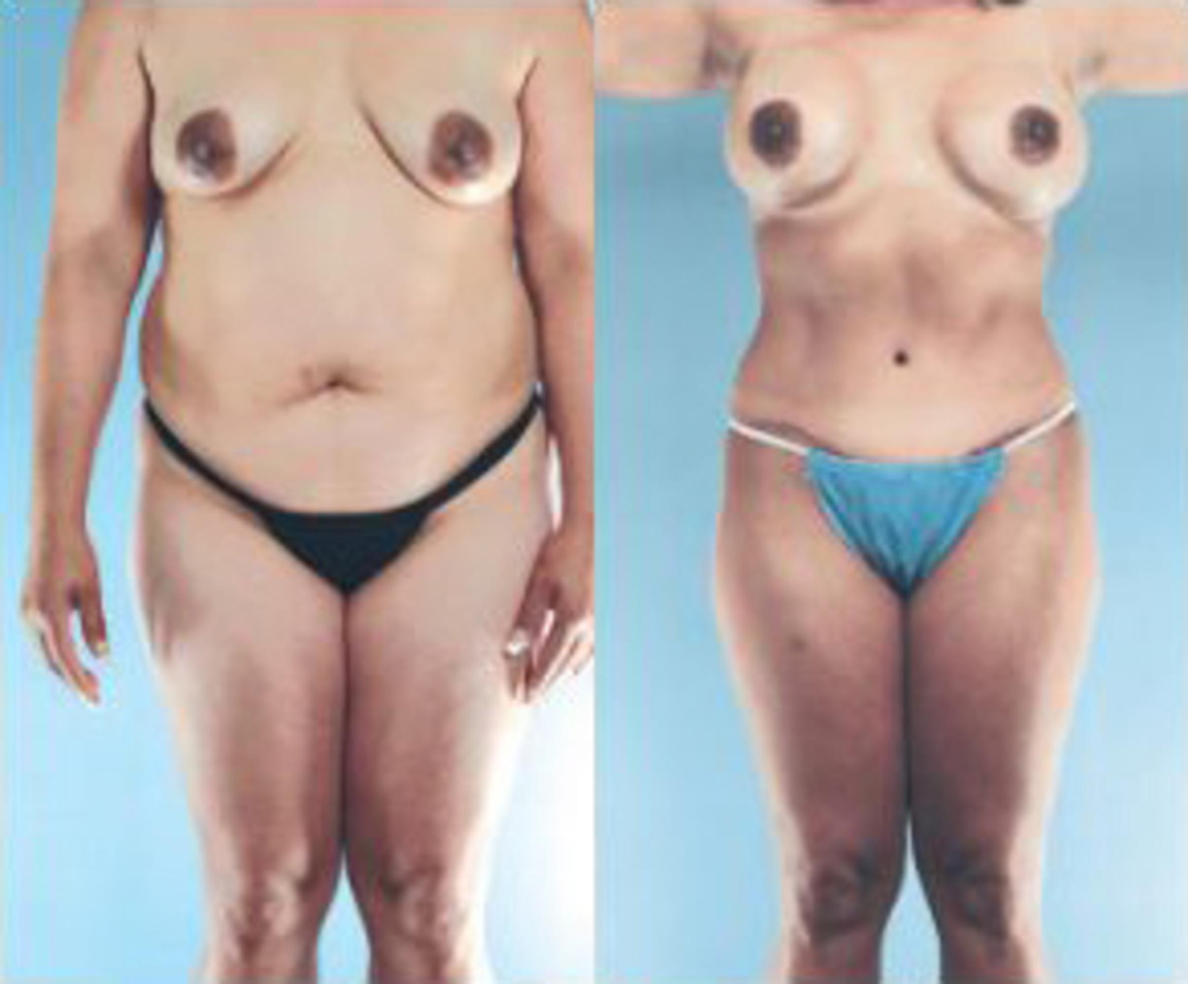 Before & After Liposuction Case 3765 View 1 View in Houston, TX