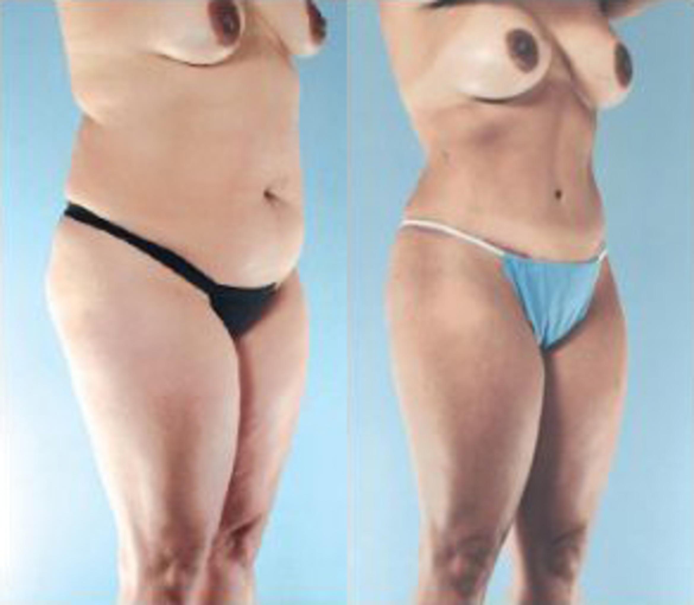 Before & After Liposuction Case 3765 View 2 View in Houston, TX