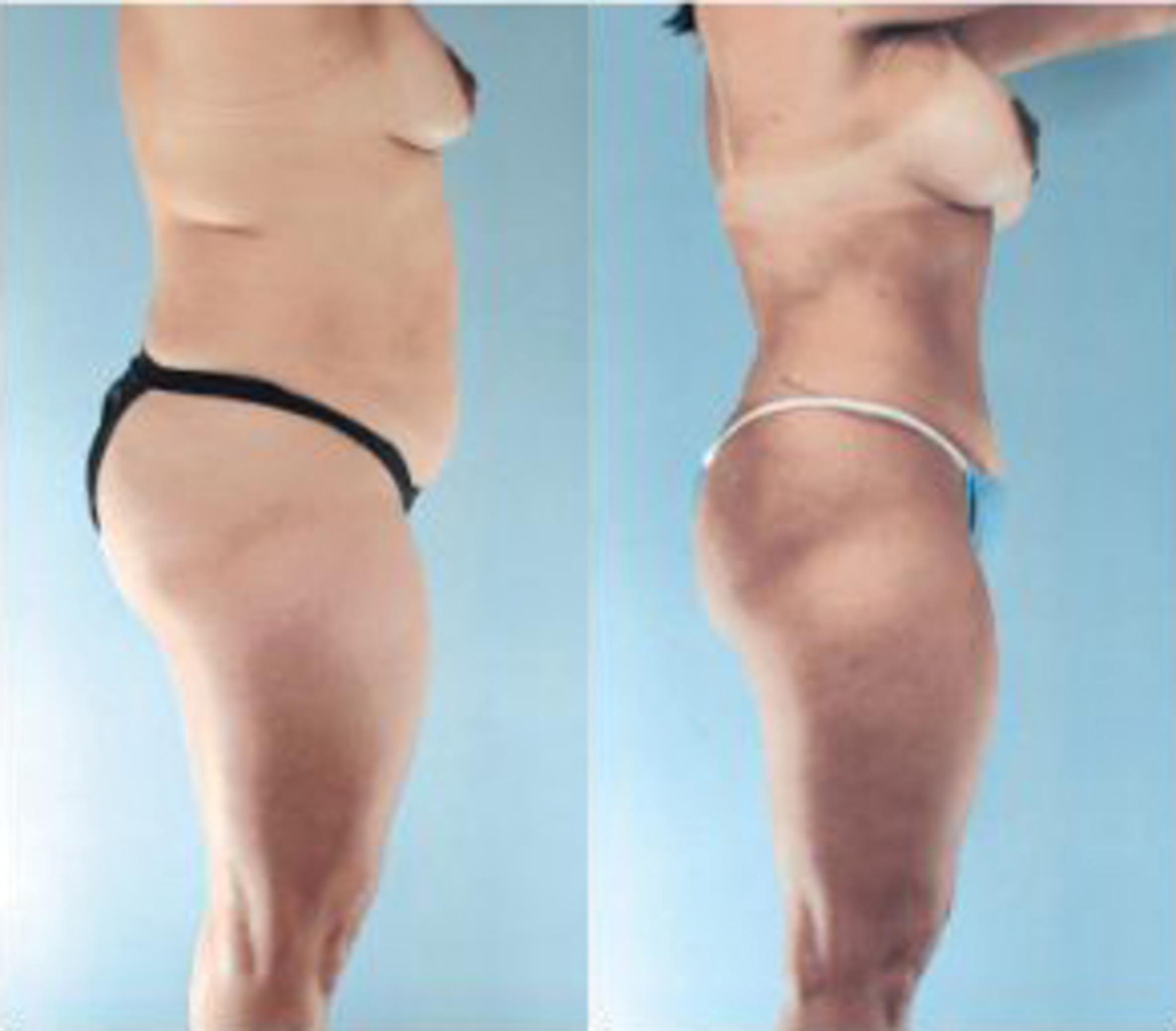 Before & After Liposuction Case 3765 View 3 View in Houston, TX