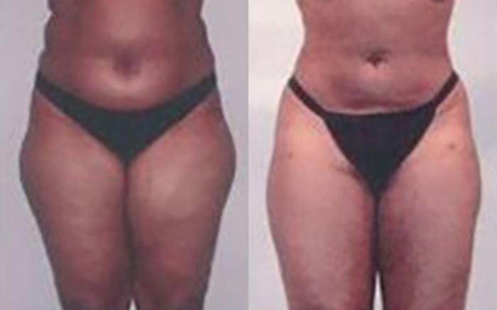 Before & After Liposuction Case 3773 View 1 View in Houston, TX