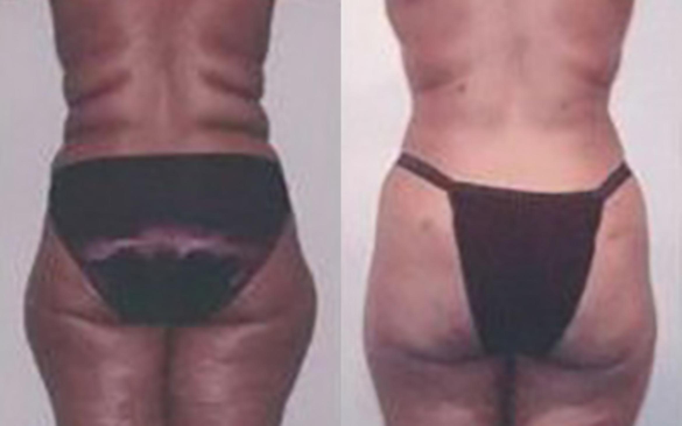 Before & After Liposuction Case 3773 View 3 View in Houston, TX