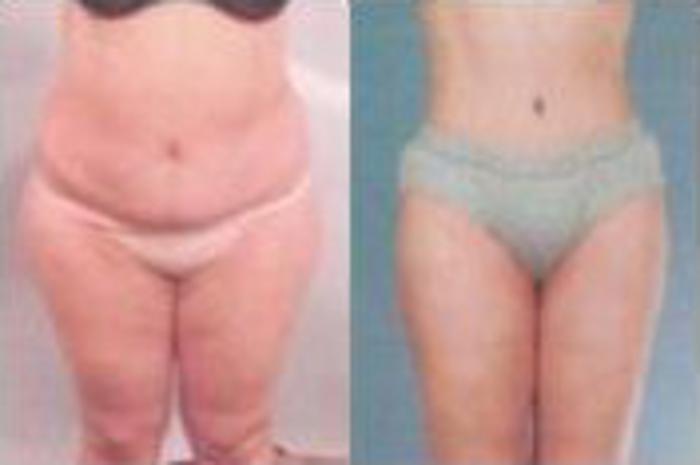 Before & After Liposuction Case 3781 View 1 View in Houston, TX