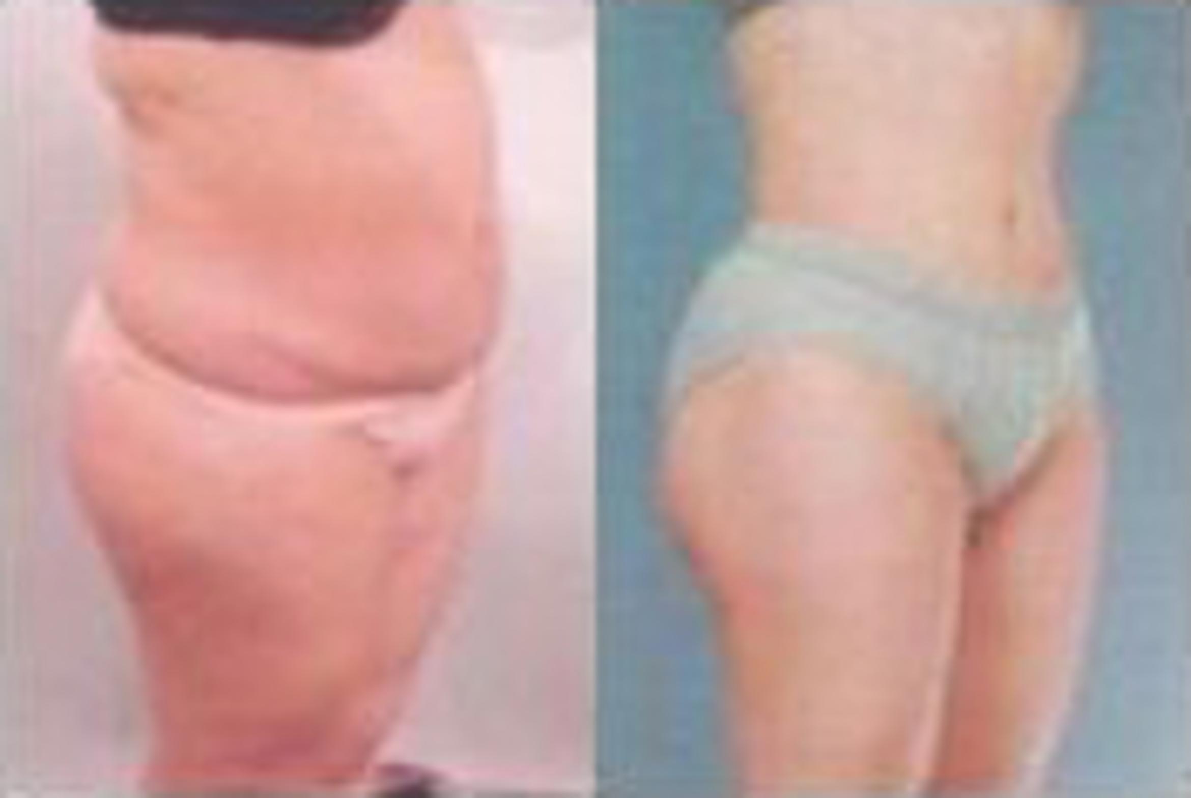 Before & After Liposuction Case 3781 View 2 View in Houston, TX