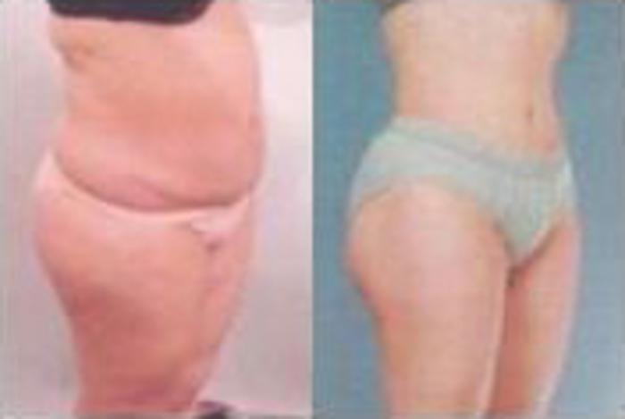 Before & After Liposuction Case 3781 View 2 View in Houston, TX