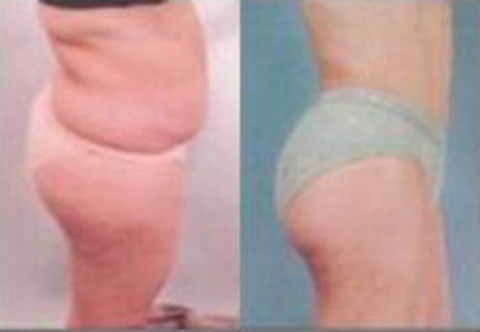 Before & After Liposuction Case 3781 View 3 View in Houston, TX