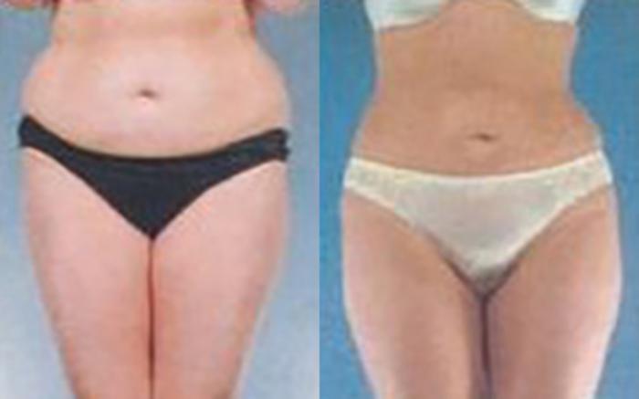 Before & After Liposuction Case 3789 View 1 View in Houston, TX