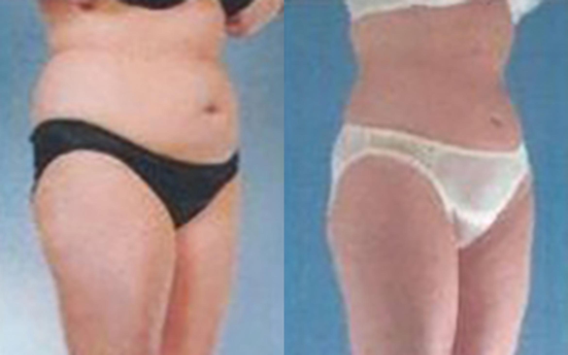 Before & After Liposuction Case 3789 View 2 View in Houston, TX