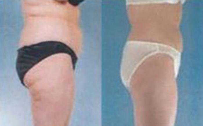 Before & After Liposuction Case 3789 View 3 View in Houston, TX