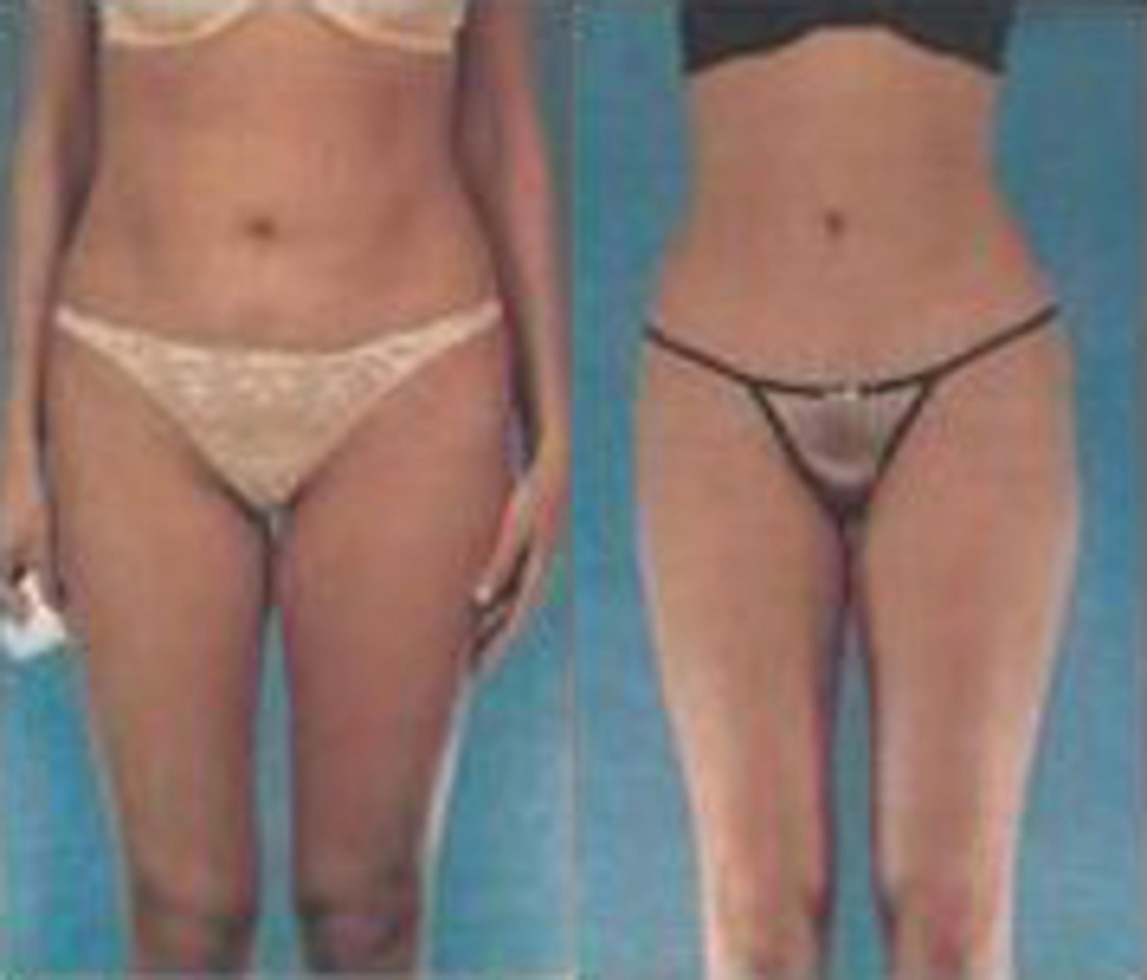 Before & After Liposuction Case 3797 View 1 View in Houston, TX