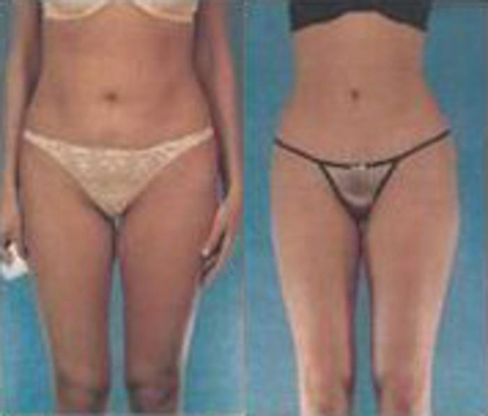 Before & After Liposuction Case 3797 View 1 View in Houston, TX