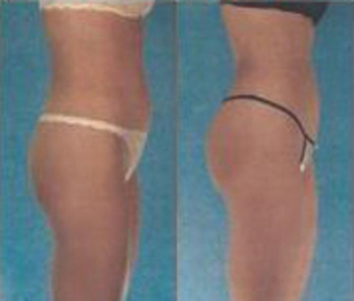 Before & After Liposuction Case 3797 View 2 View in Houston, TX