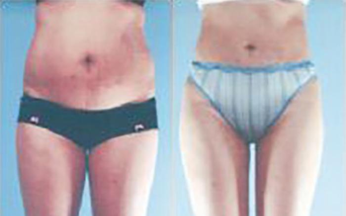 Before & After Liposuction Case 3803 View 1 View in Houston, TX