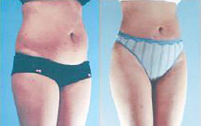 Before & After Liposuction Case 3803 View 2 View in Houston, TX