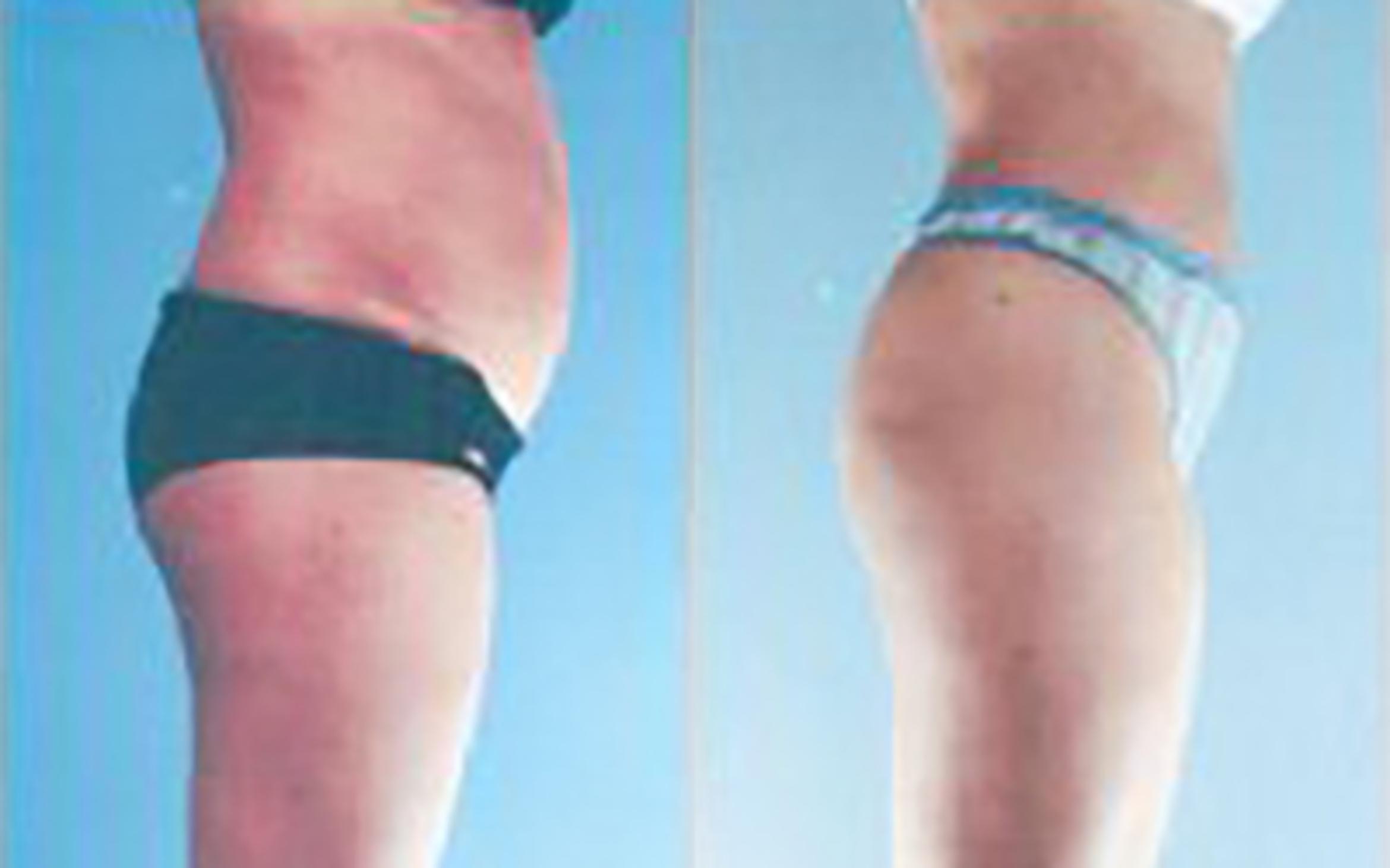 Before & After Liposuction Case 3803 View 3 View in Houston, TX