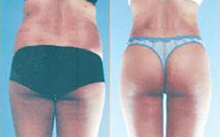 Before & After Liposuction Case 3803 View 4 View in Houston, TX