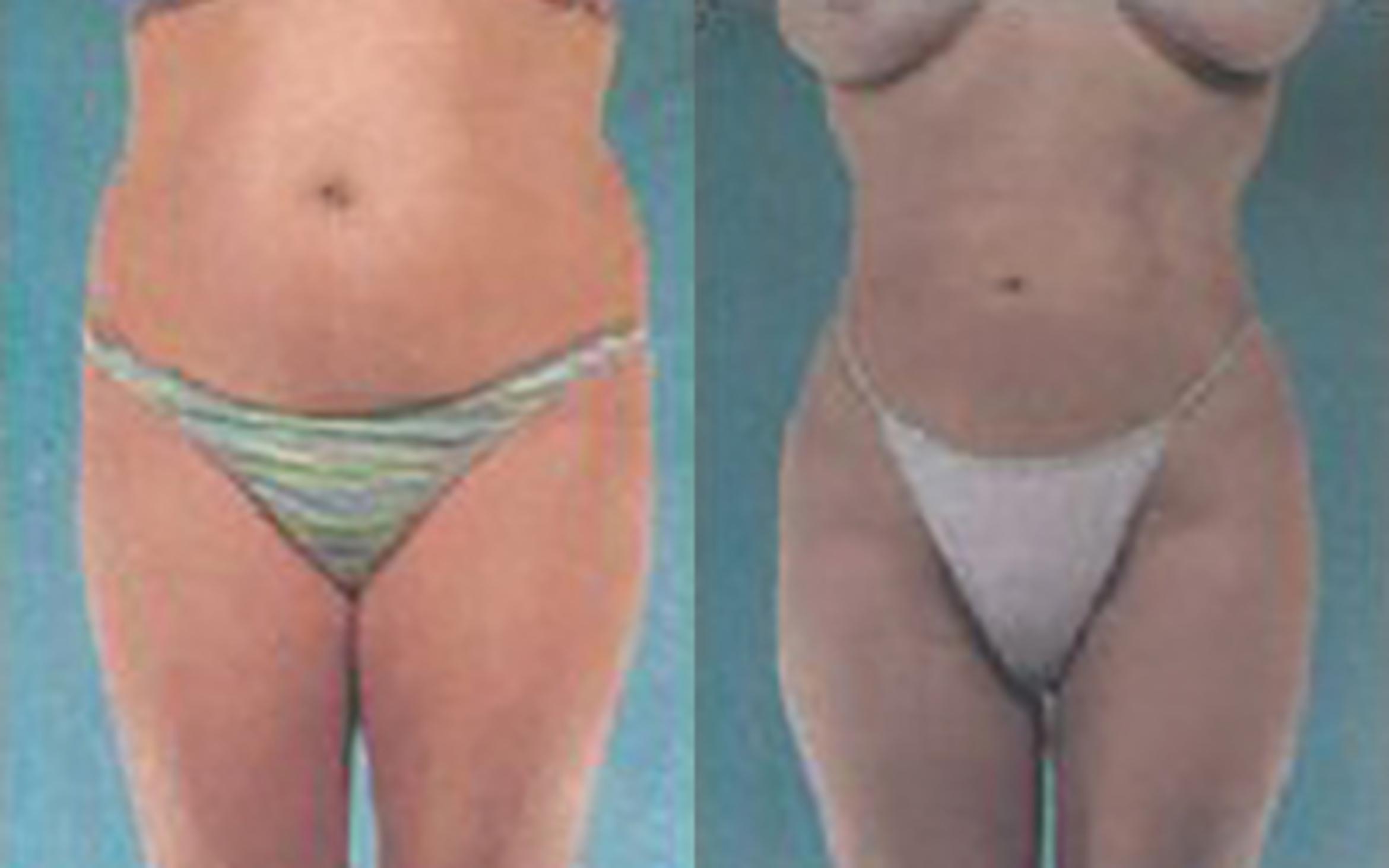 Before & After Liposuction Case 3813 View 1 View in Houston, TX