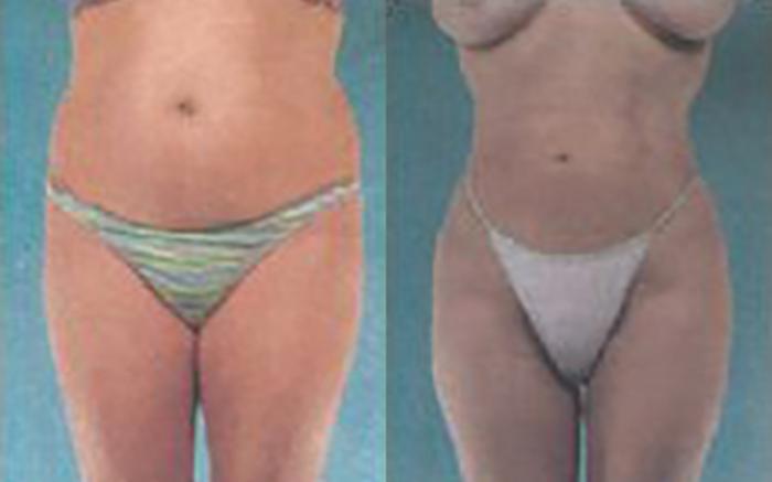 Before & After Liposuction Case 3813 View 1 View in Houston, TX