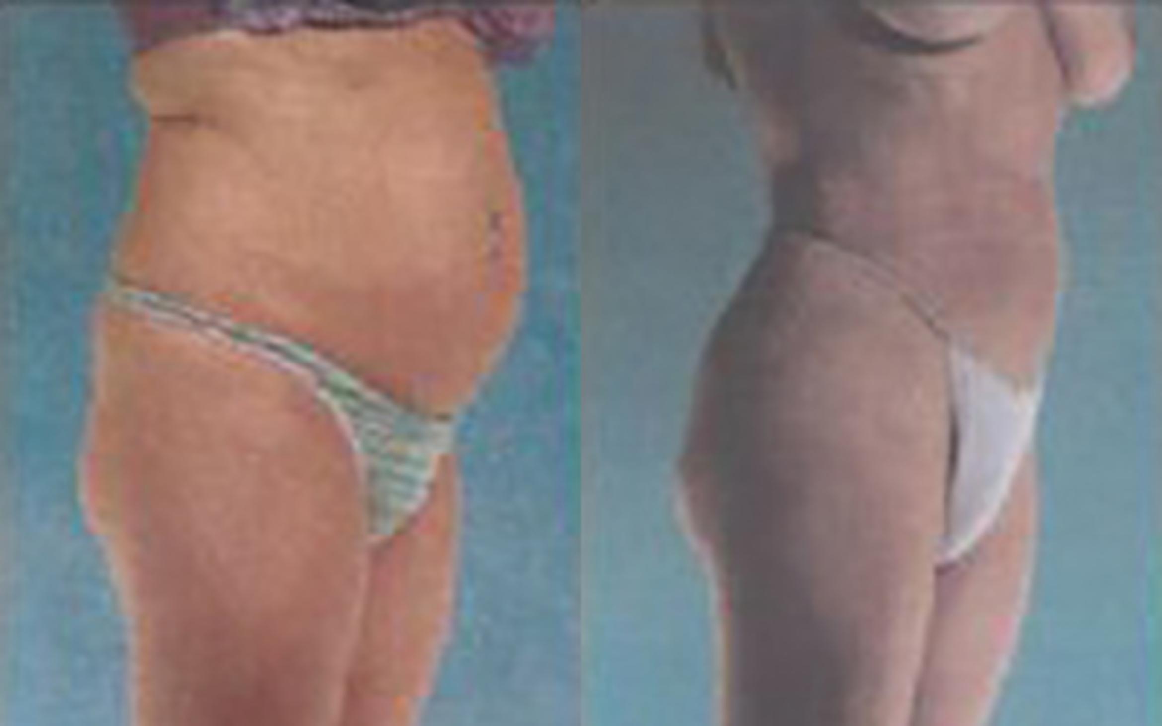 Before & After Liposuction Case 3813 View 2 View in Houston, TX