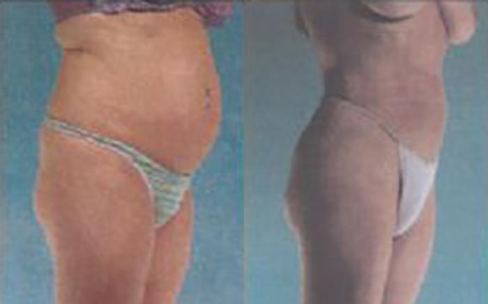 Before & After Liposuction Case 3813 View 2 View in Houston, TX