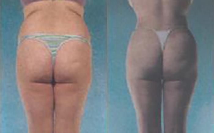 Before & After Liposuction Case 3813 View 3 View in Houston, TX