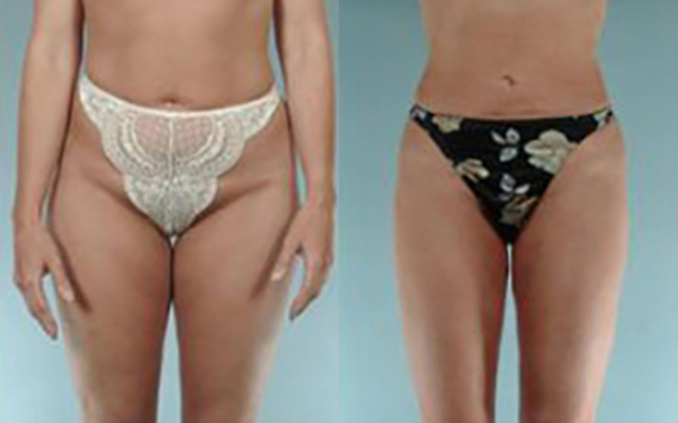 Before & After Liposuction Case 3821 View 1 View in Houston, TX