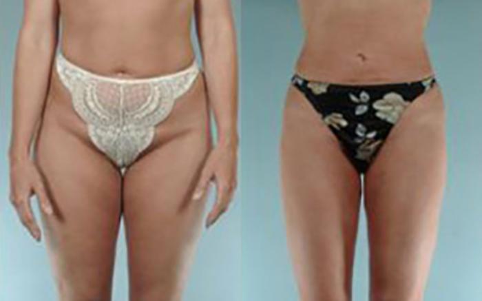 Before & After Liposuction Case 3821 View 1 View in Houston, TX