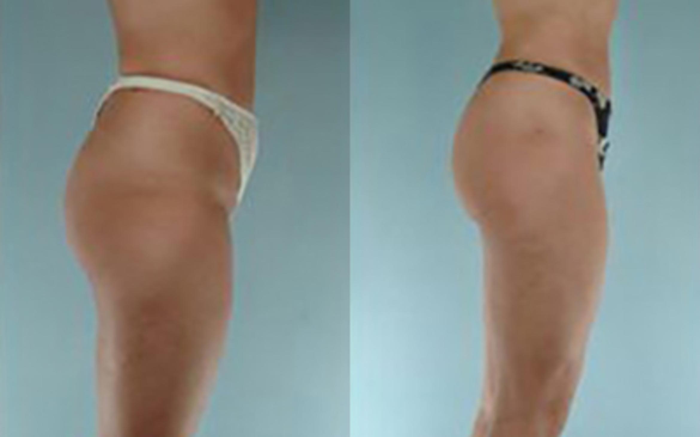 Before & After Liposuction Case 3821 View 2 View in Houston, TX