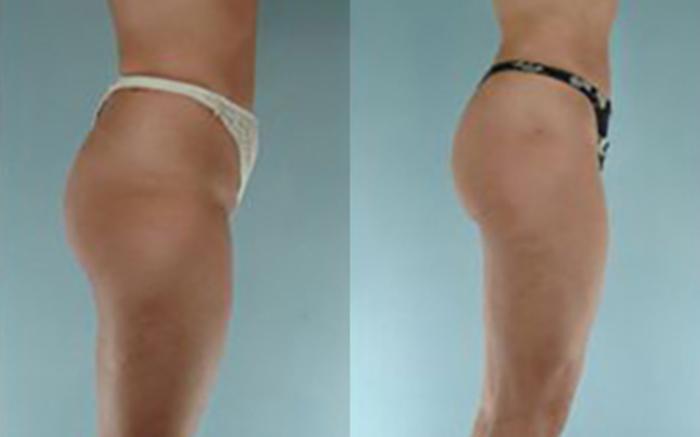 Before & After Liposuction Case 3821 View 2 View in Houston, TX