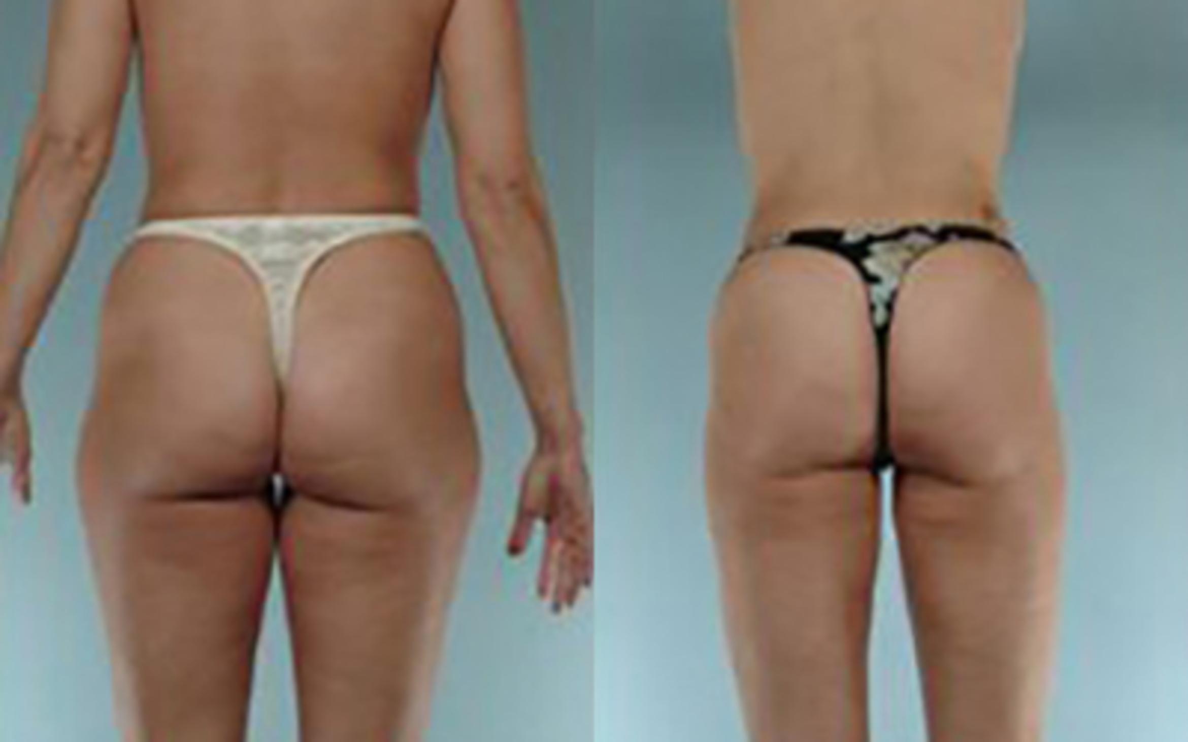 Before & After Liposuction Case 3821 View 3 View in Houston, TX