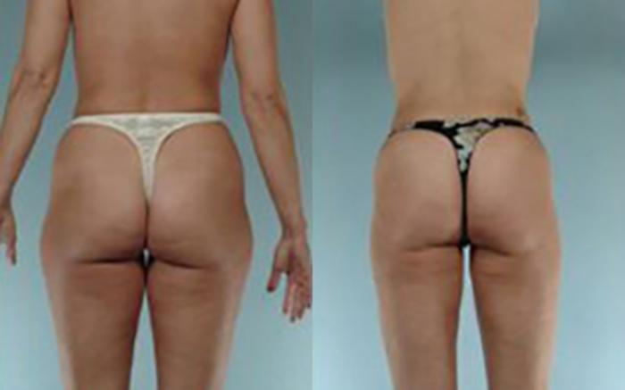 Before & After Liposuction Case 3821 View 3 View in Houston, TX