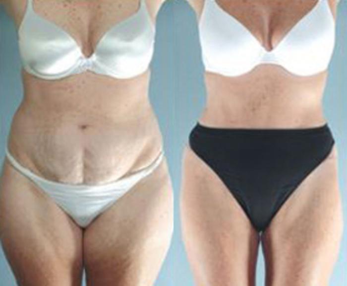 Before & After Liposuction Case 3829 View 1 View in Houston, TX
