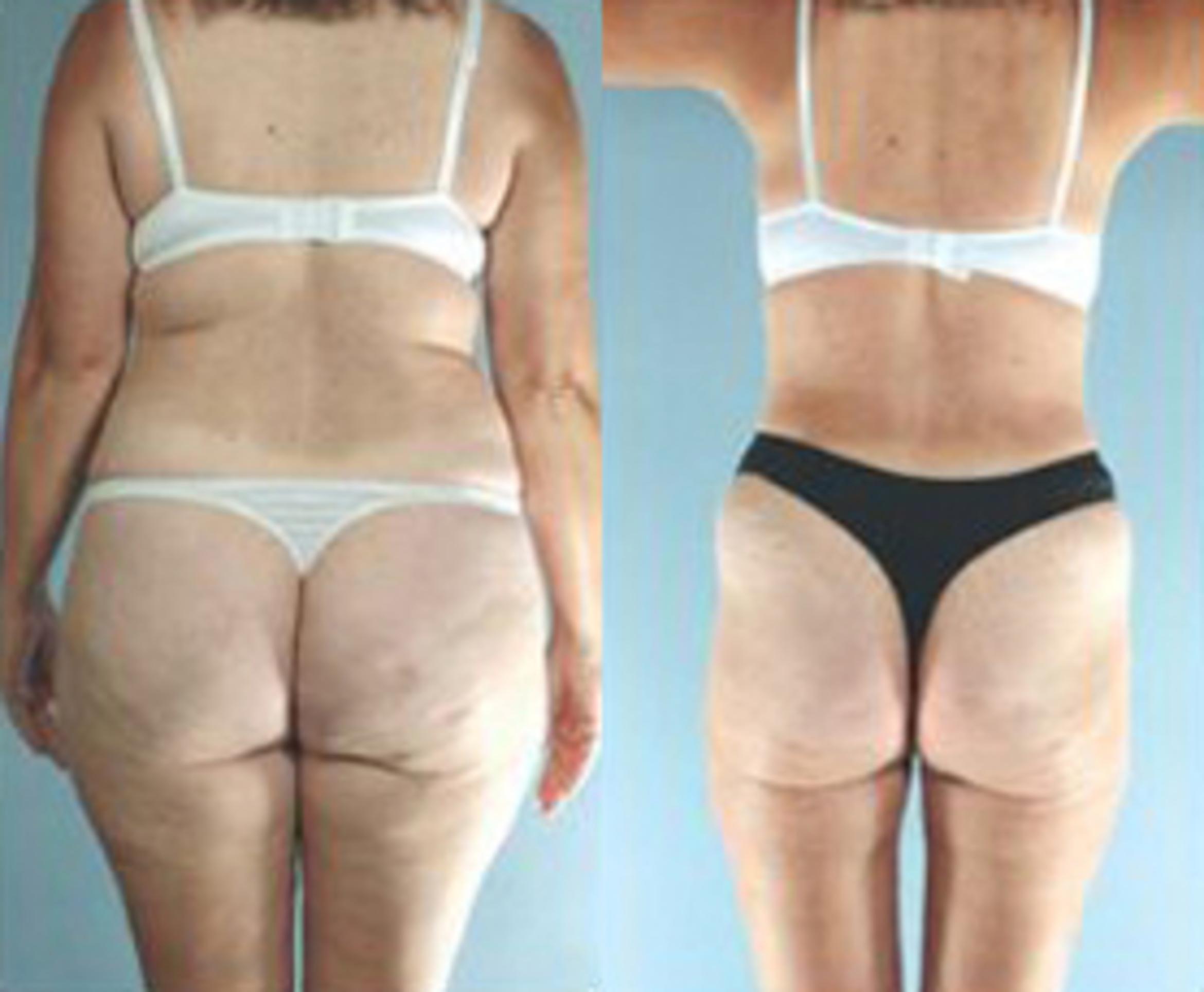 Before & After Liposuction Case 3829 View 2 View in Houston, TX