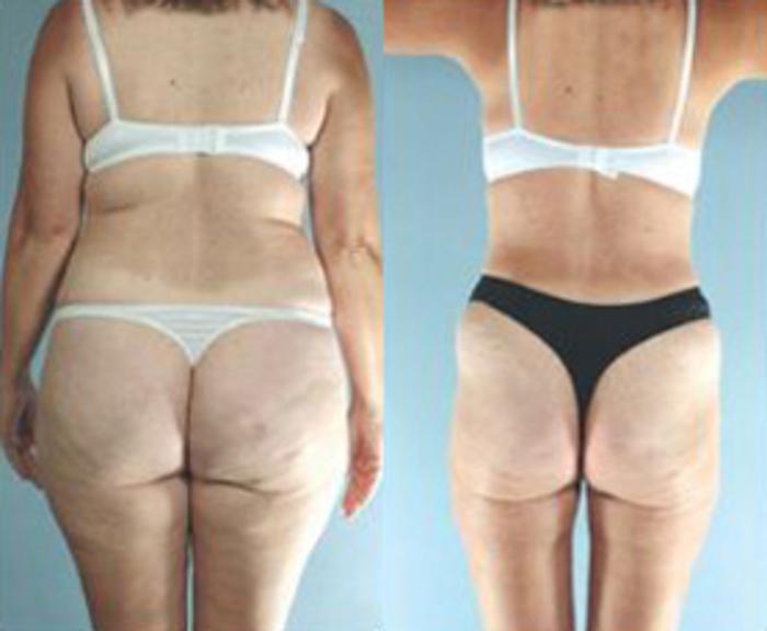 Before & After Liposuction Case 3829 View 2 View in Houston, TX