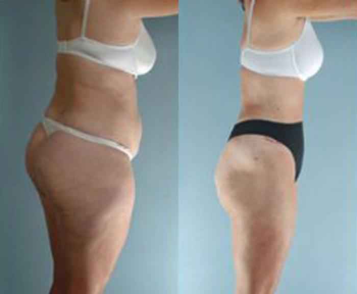 Before & After Liposuction Case 3829 View 3 View in Houston, TX